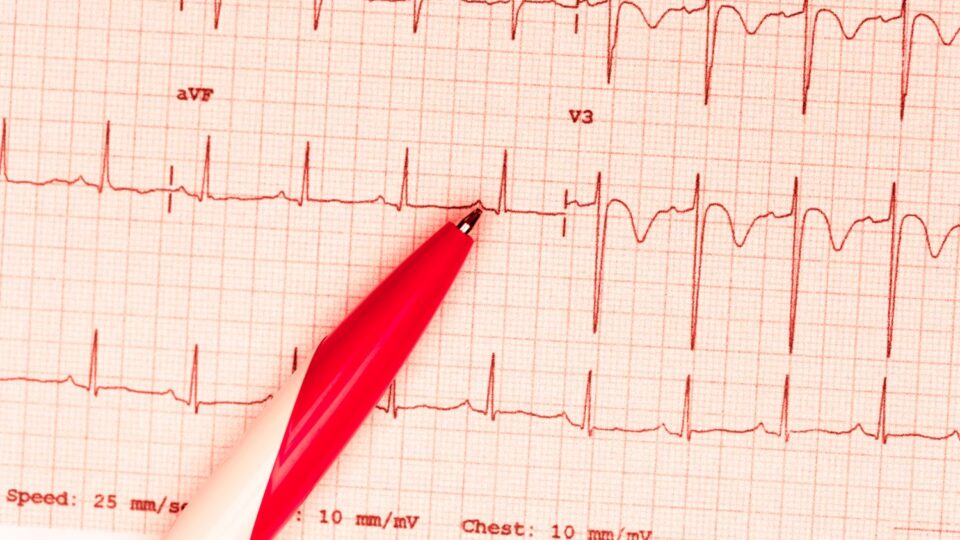 Electrocardiograma - Ondas Arteriales - Cellmedik