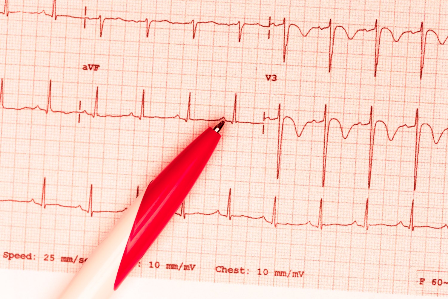 Electrocardiograma - Ondas Arteriales - Cellmedik